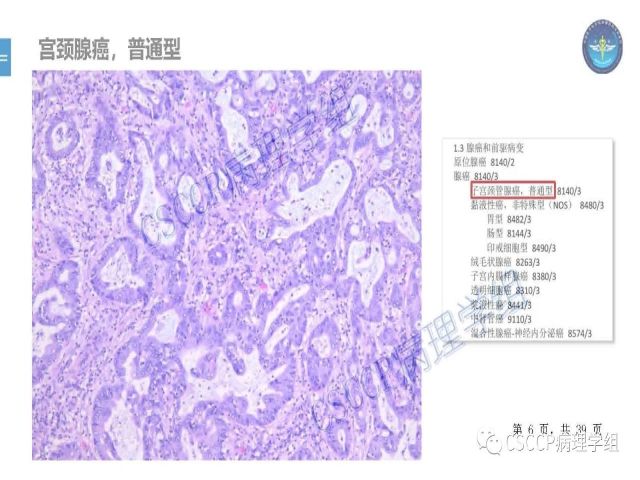 黄文亭 张询：宫颈腺癌分类介绍