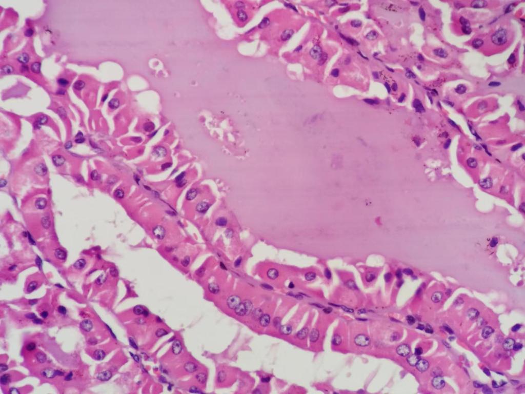 是大汗腺癌还是甲状腺癌转移？