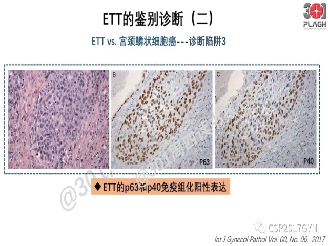 中间型滋养细胞肿瘤的诊断及鉴别诊断