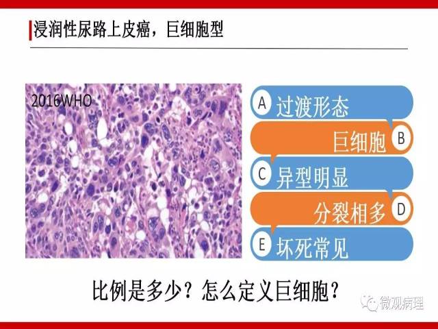 泌尿课程/浸润性尿路上皮癌病理学类型