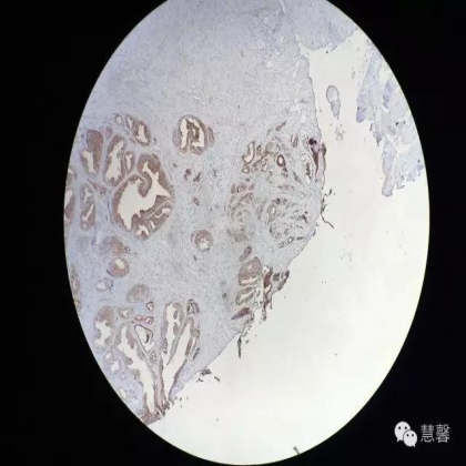 前列腺腺癌？（芳分享病例，华夏泌尿群讨论，孔祥田老师讲解）