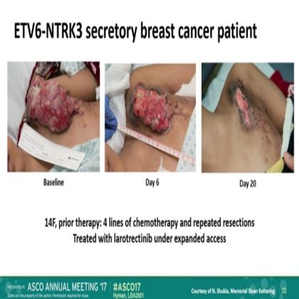 The efficacy of LOXO-101,a selective TRKI, in adult and pediatric TRK fusion cancers