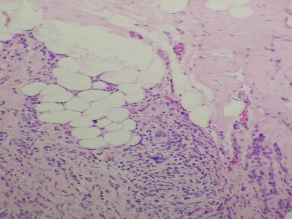 组织学1级的乳腺浸润性导管癌（札记七十五）