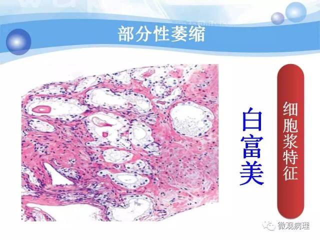 泌尿课程/局灶性前列腺萎缩