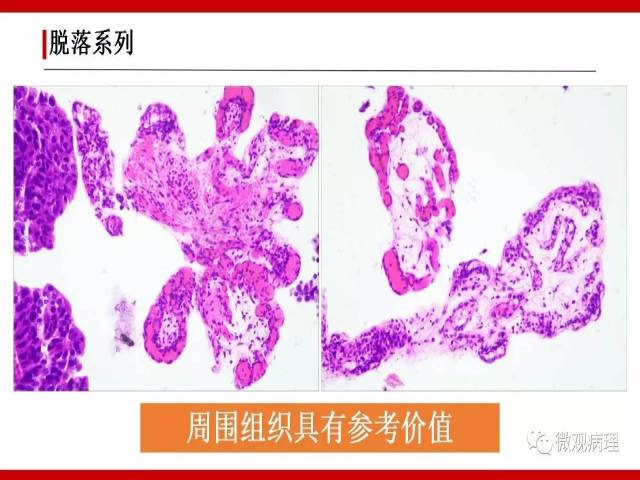 泌尿课程/非浸润性尿路上皮病变诊断的一些困惑