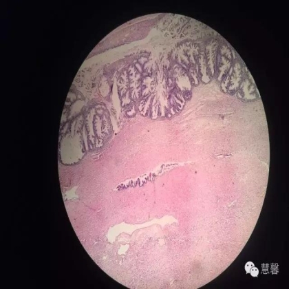 交界性黏液性囊腺瘤？癌？（魏娉分享，刘从容老师讲解）