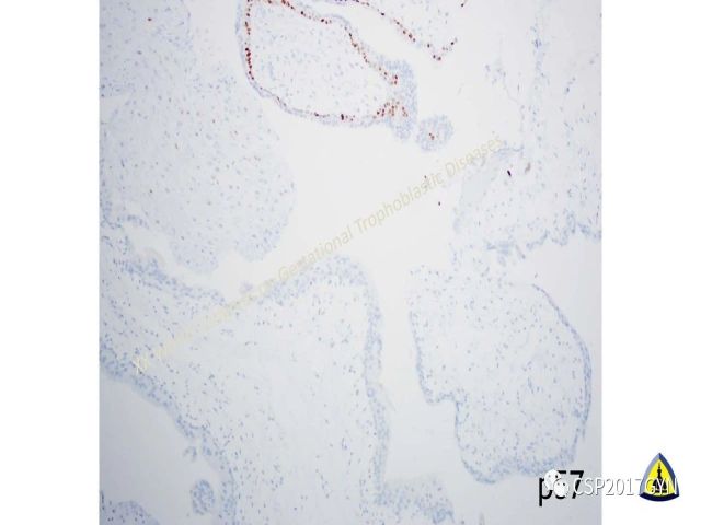 p57免疫组化染色及基因分型 在葡萄胎精确诊断中的应用