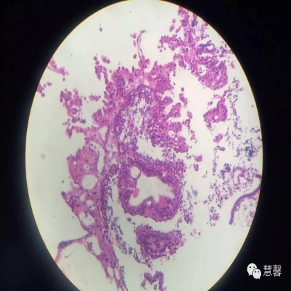 子宫内膜乳头状增生（甜甜分享病例，孔祥田(Max)*Roswell*老师讲解，kent翻译整理文献）