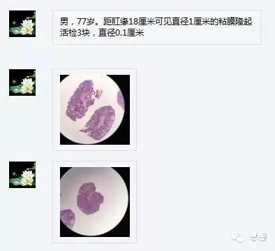 结、直肠管绒毛状腺瘤-高级别病变诊断等相关问题2（悄悄分享、孔祥田(Max)*Roswell*老师讲解）