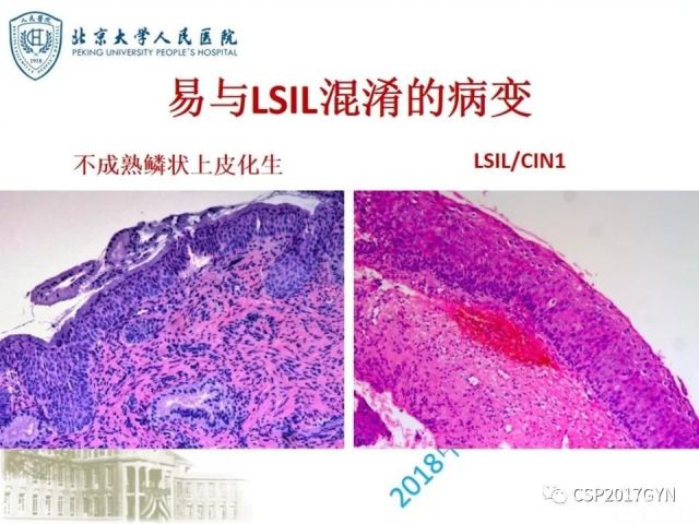 宫颈鳞状上皮内病变病理诊断中问题