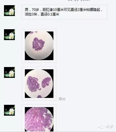 结、直肠管绒毛状腺瘤-高级别病变诊断等相关问题2（悄悄分享、孔祥田(Max)*Roswell*老师讲解）