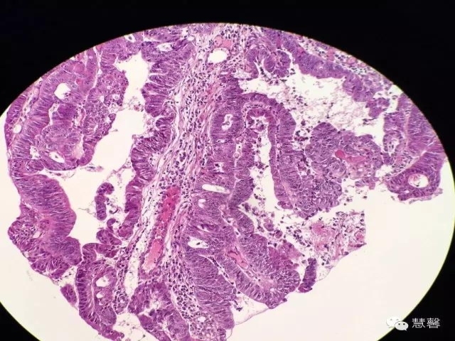 结、直肠管绒毛状腺瘤-高级别病变诊断等相关问题2（悄悄分享、孔祥田(Max)*Roswell*老师讲解）
