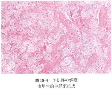第四集：四大《痛性皮下结节》