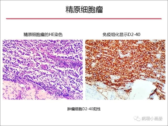 泌尿病理--精原细胞瘤VS精母细胞瘤