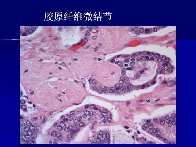 前列腺病理诊断线索（上）——黄教悌