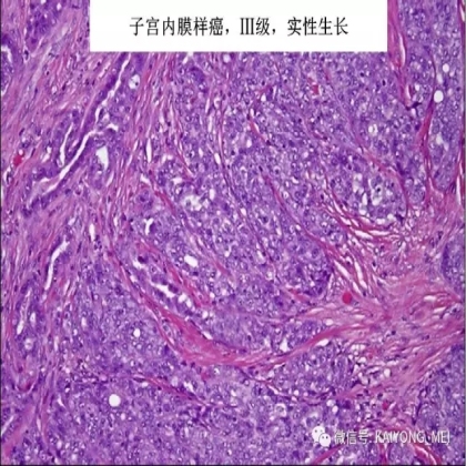 卵巢癌的病理诊断新进展（二）