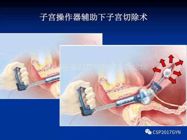 子宫内膜癌：诊断与进展