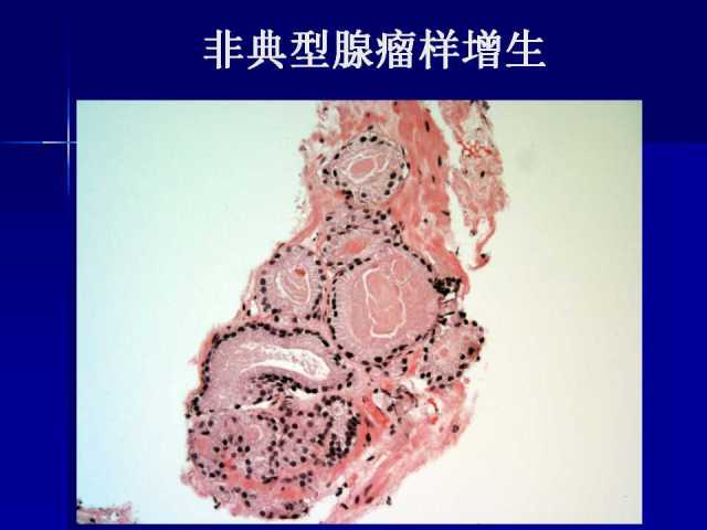 前列腺病理诊断线索（下）——黄教悌