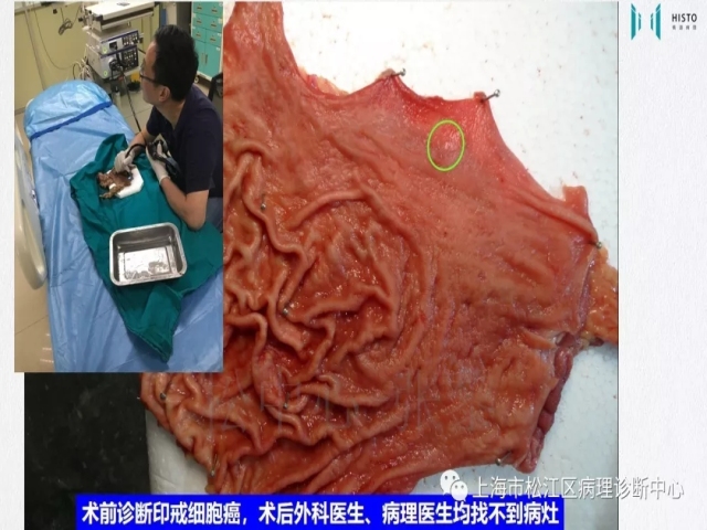 上消化道早癌病理诊断中的困惑及基本对策回顾