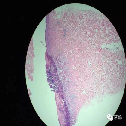 Acquired perforating dermatosis（孔祥田(Max)*Roswell*NM]分享及讲解）