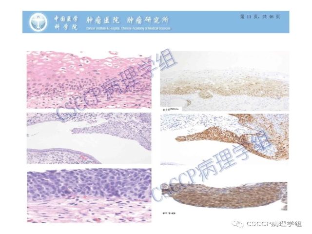 宫颈癌前病变中的诊断难点及阴道镜中ECC的 应用价值