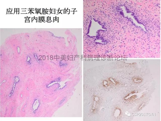 子宫内膜假肿瘤性病变及类似癌样病变
