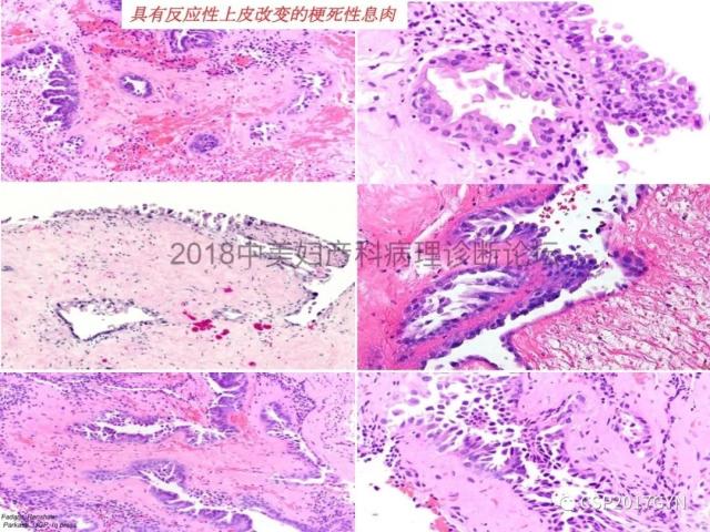 子宫内膜假肿瘤性病变及类似癌样病变