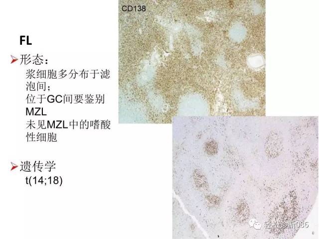 浆细胞相关肿瘤的病理诊断及鉴别诊断