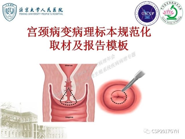 中华病理学会基层培训遵义站讲座（三）——宫颈鳞状上皮病变的病理诊断与鉴别诊断