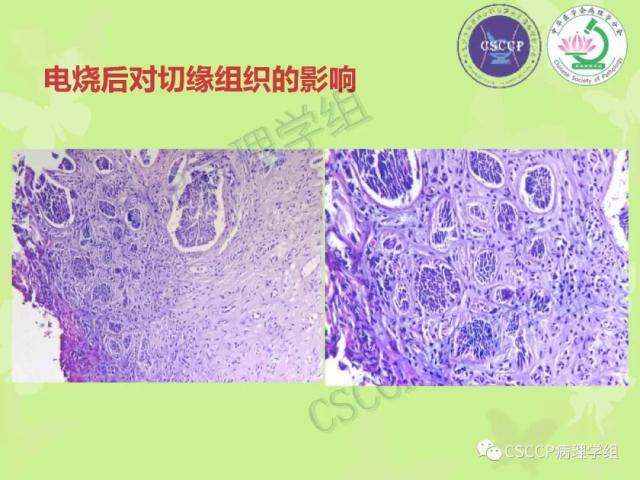 宫颈与子宫病变病理标本取材