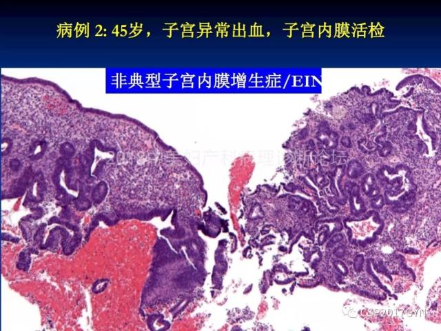 子宫内膜癌：诊断与进展