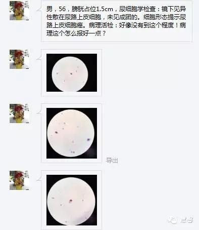 尿路上皮乳头状瘤、低级别尿路上皮乳头状癌的诊断及鉴别诊断，再听孔祥田(Max)*Roswell*NM老师讲解