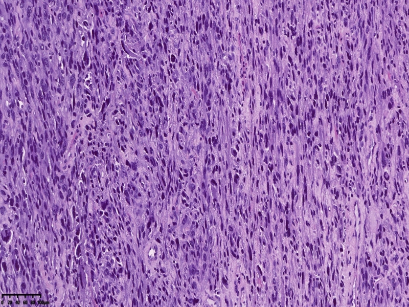 子宫平滑肌肉瘤? 子宫平滑肌肉瘤?