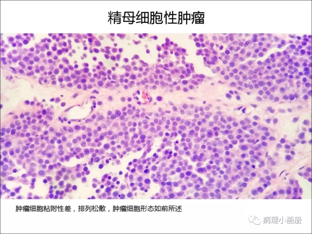 泌尿病理--精原细胞瘤VS精母细胞瘤
