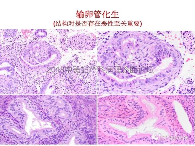子宫内膜假肿瘤性病变及类似癌样病变