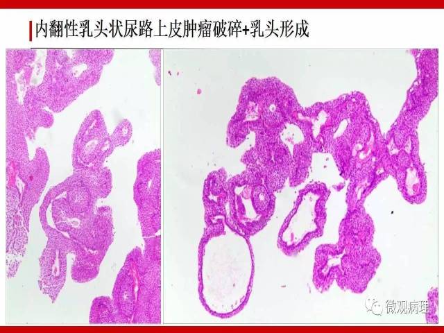 膀胱尿路上皮肿瘤诊断的一些困惑