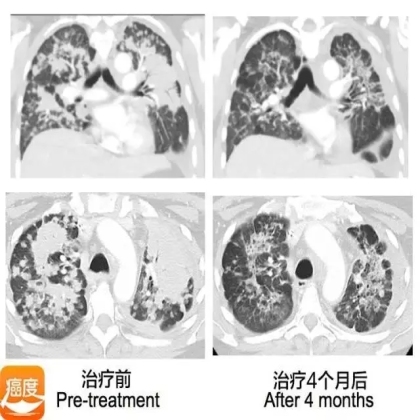 EGFR和HER2基因20外显子插入突变的用药问题