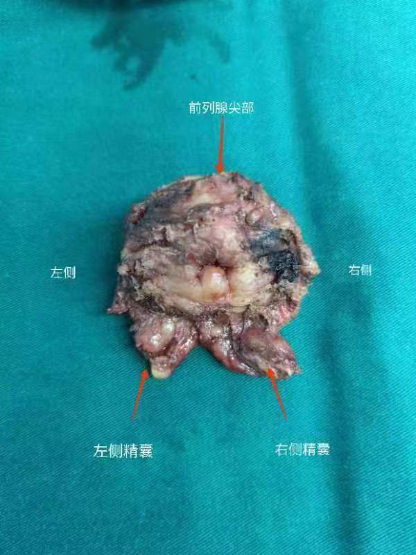 前列腺癌诊断的听课笔记（八十五）