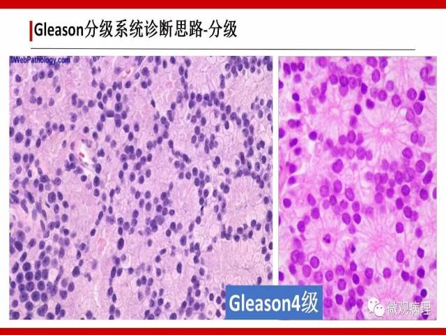 前列腺癌Gleason分级系统的前世今生