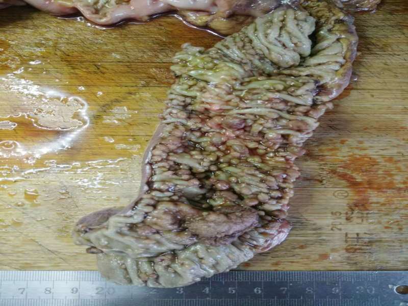 病理科工作札记（二十五）家族性大肠腺瘤病