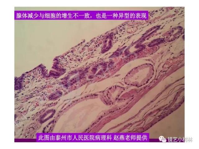上消化道早癌病理的学习心得体会（附胃牵手癌的病例特点文献学习）