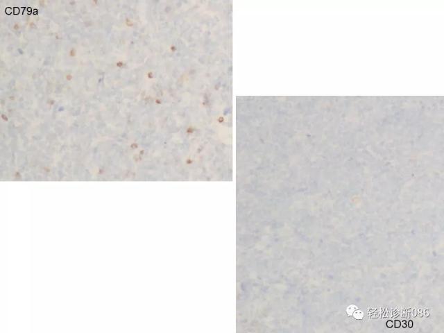 BPDCN病例分享