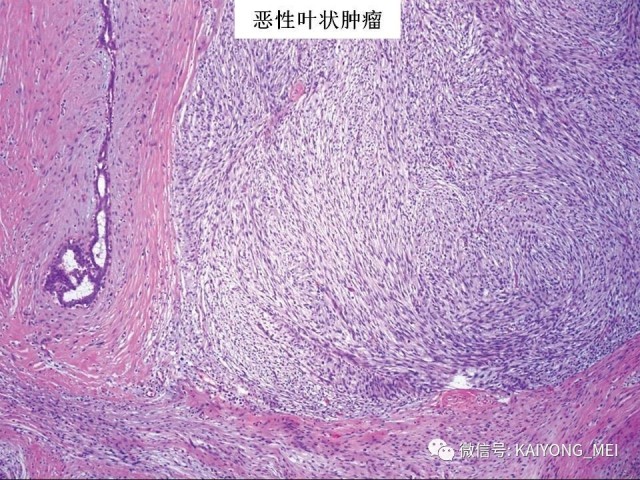 乳腺梭形细胞病变的病理诊断及进展（二）