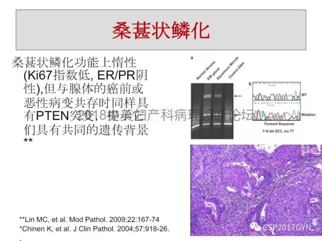 子宫内膜假肿瘤性病变及类似癌样病变