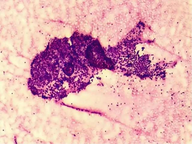 以甲状腺为例谈谈病理诊断那些事 以甲状腺为例谈谈病理诊断那些事