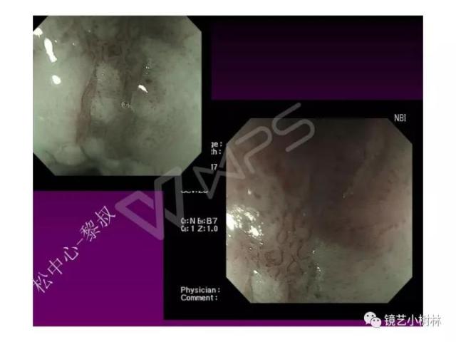 上消化道早癌病理的学习心得体会（附胃牵手癌的病例特点文献学习）