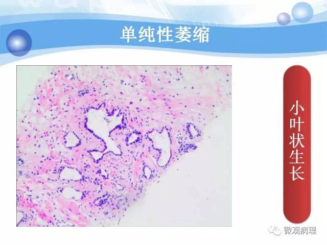 泌尿课程/局灶性前列腺萎缩