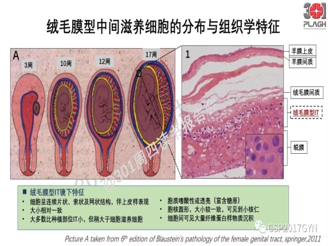 中间型滋养细胞肿瘤的诊断及鉴别诊断
