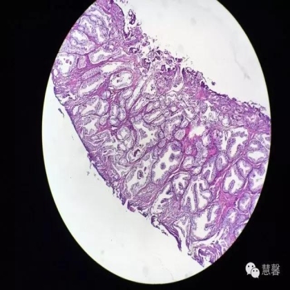 前列腺腺癌？（芳分享病例，华夏泌尿群讨论，孔祥田老师讲解）