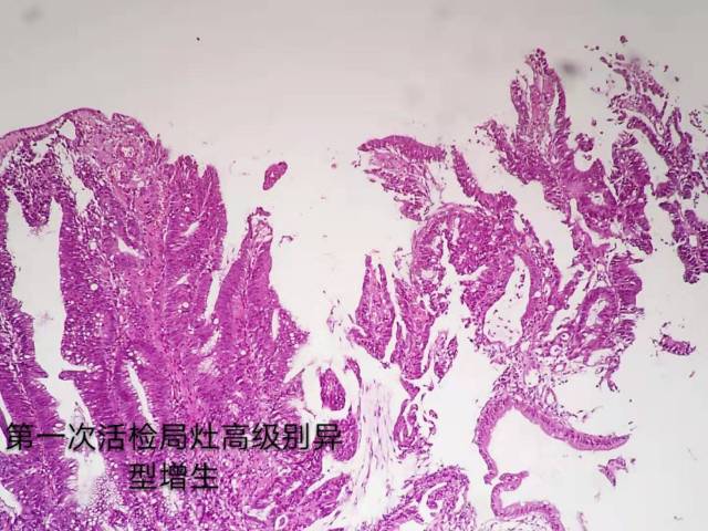 病理科工作札记（三十五）二次活检